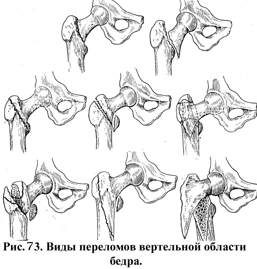 Закрытый чрезвертельный варусный перелом левого бедра с отрывом малого вертела (рис. 4) Закрытый чрезвертельный варусный перелом левого бедра с отрывом малого вертела (рис. 4)