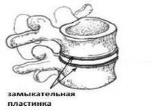 Дегенеративно-дистрофические поражения позвоночника. Грыжи дисков. Диско-радикулярный конфликт. Хирургическое лечение (рис. 2) Дегенеративно-дистрофические поражения позвоночника. Грыжи дисков. Диско-радикулярный конфликт. Хирургическое лечение (рис. 2)