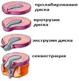 Дегенеративно-дистрофические поражения позвоночника. Грыжи дисков. Диско-радикулярный конфликт. Хирургическое лечение (рис. 6) Дегенеративно-дистрофические поражения позвоночника. Грыжи дисков. Диско-радикулярный конфликт. Хирургическое лечение (рис. 6)