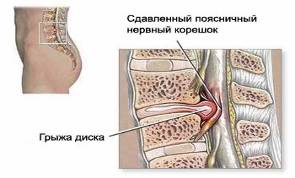 Дегенеративно-дистрофические поражения позвоночника. Грыжи дисков. Диско-радикулярный конфликт. Хирургическое лечение (рис. 8) Дегенеративно-дистрофические поражения позвоночника. Грыжи дисков. Диско-радикулярный конфликт. Хирургическое лечение (рис. 8)