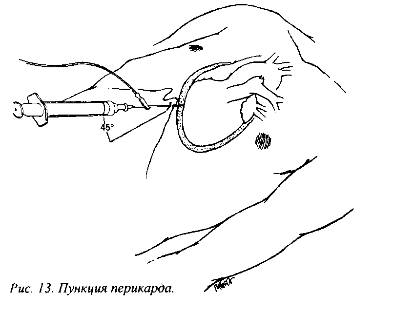 КЛИНИЧЕСКАЯ КАРТИНА, ДИАГНОСТИКА И ЛЕЧЕНИЕ ВЫПОТНЫХ ПЕРИКАРДИТОВ ПО МАТЕРИАЛАМ ГОКБ (рис. 1) КЛИНИЧЕСКАЯ КАРТИНА, ДИАГНОСТИКА И ЛЕЧЕНИЕ ВЫПОТНЫХ ПЕРИКАРДИТОВ ПО МАТЕРИАЛАМ ГОКБ (рис. 1)