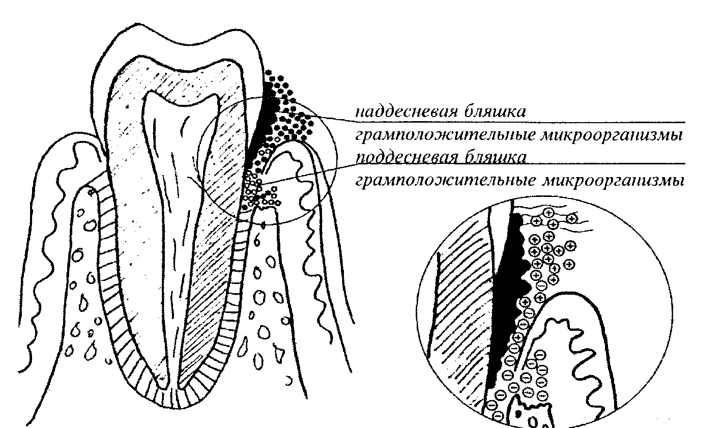 Первичные факторы в этиологии и патогенезе воспалительных заболеваний пародонта (рис. 1) Первичные факторы в этиологии и патогенезе воспалительных заболеваний пародонта (рис. 1)
