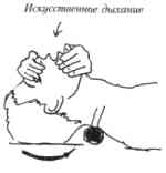 ОКАЗАНИЕ ПЕРВОЙ МЕДИЦИНСКОЙ ПОМОЩИ ПРИ ЭКСТРЕМАЛЬНЫХ ВИДАХ СПОРТА ПАРАПЛАНЕРИЗМ (рис. 16) ОКАЗАНИЕ ПЕРВОЙ МЕДИЦИНСКОЙ ПОМОЩИ ПРИ ЭКСТРЕМАЛЬНЫХ ВИДАХ СПОРТА ПАРАПЛАНЕРИЗМ (рис. 16)