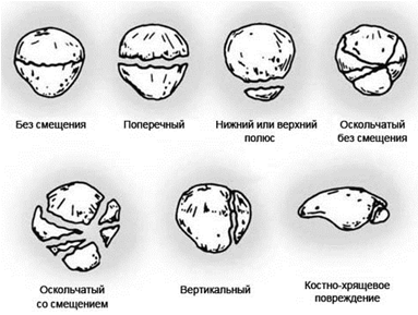 Расчет характеристик имплантата для лечения поперечного перелома надколенника (рис. 2) Расчет характеристик имплантата для лечения поперечного перелома надколенника (рис. 2)
