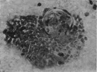 Полиомиелит: патологическая анатомия и локализация морфологических изменений в нервной системе (рис. 2) Полиомиелит: патологическая анатомия и локализация морфологических изменений в нервной системе (рис. 2)