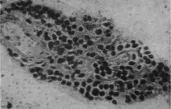 Полиомиелит: патологическая анатомия и локализация морфологических изменений в нервной системе (рис. 3) Полиомиелит: патологическая анатомия и локализация морфологических изменений в нервной системе (рис. 3)