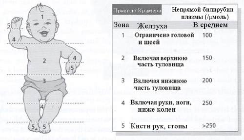 Что такое желтуха у новорожденных? (рис. 3) Что такое желтуха у новорожденных? (рис. 3)